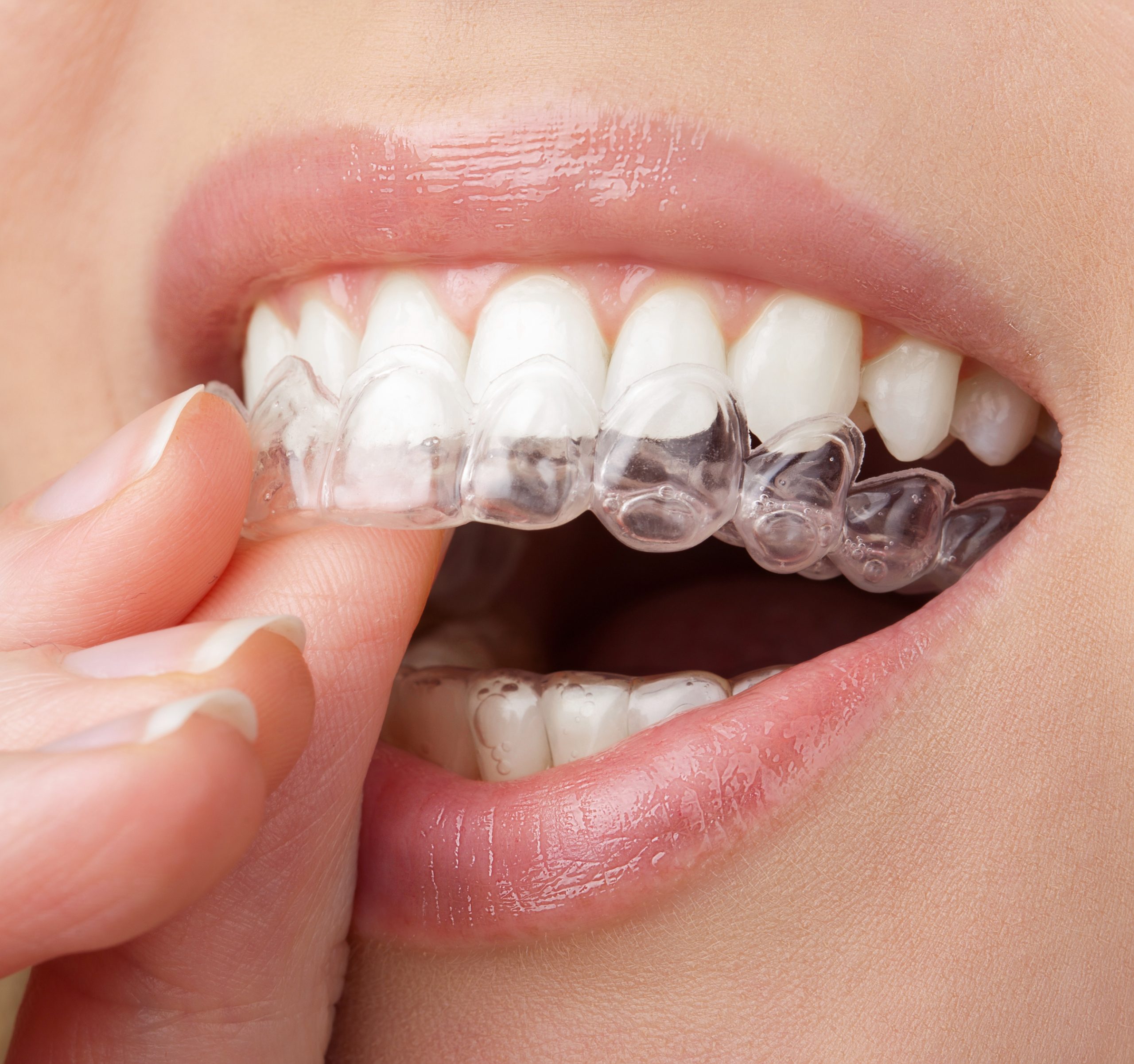 Young woman holding whitening tray with gel - home teeth whitening procedure - Tandhälsan A6 Jönköping - Dentist in Jönköping