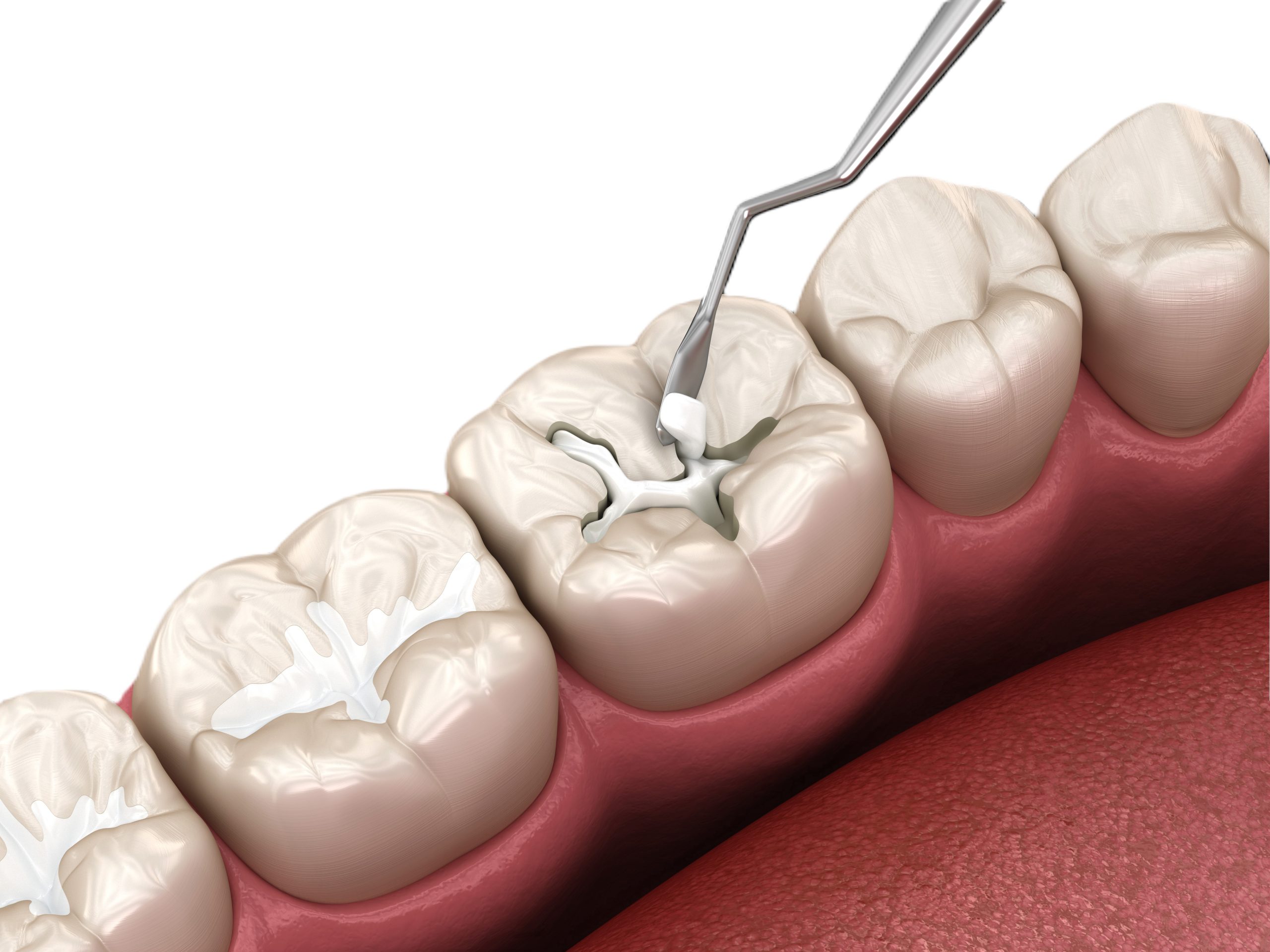 Dental repair using composite and dental tools at Tandhälsan A6 Jönköping - Dentists in Jönköping